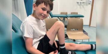 Revolucion në mjekësi/ 9-vjeçari në Britani bëhet fëmija i parë që iu nënshtrua një operacioni për zgjatjen e këmbës